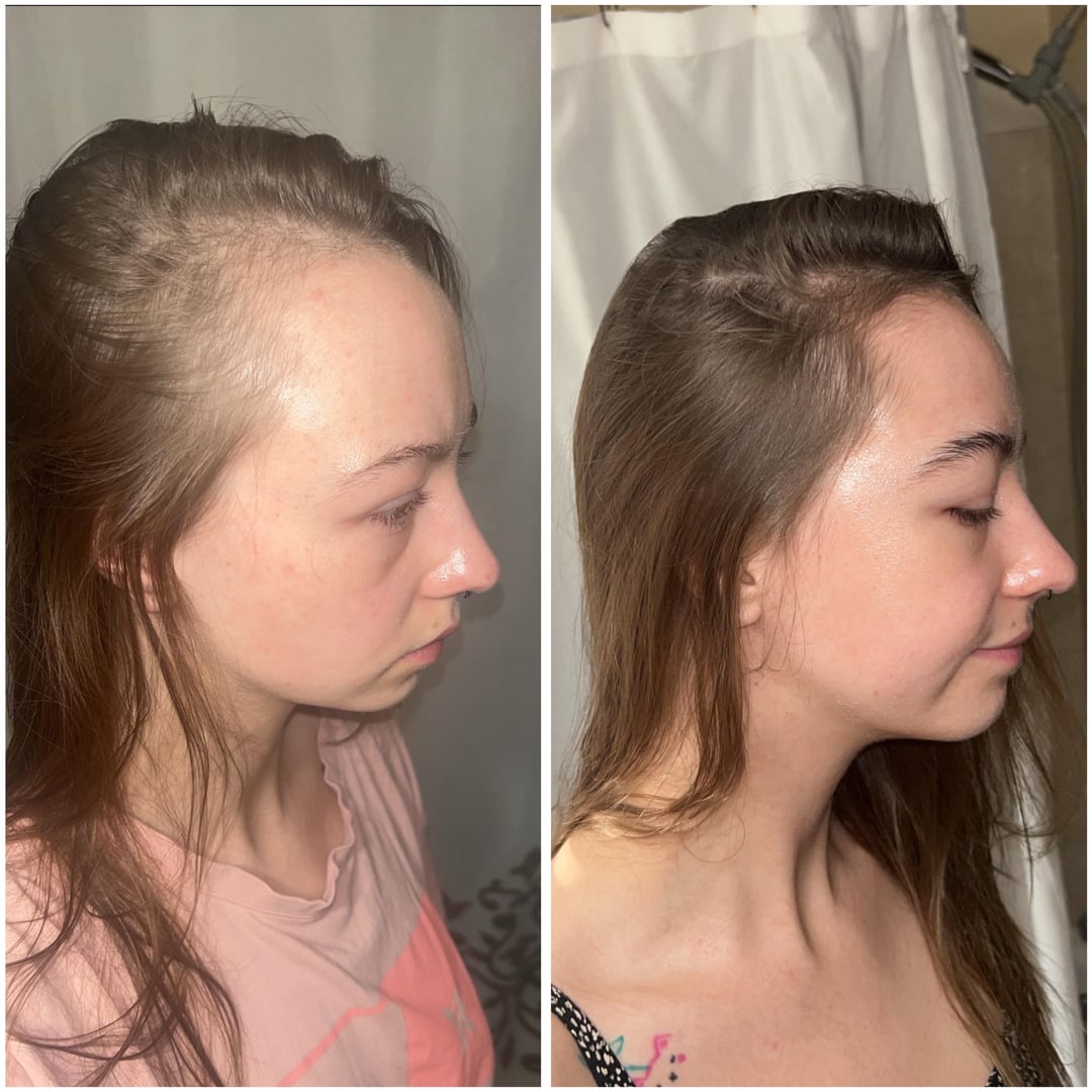 Does Rogaine Work for Women? FAQ & Real Results