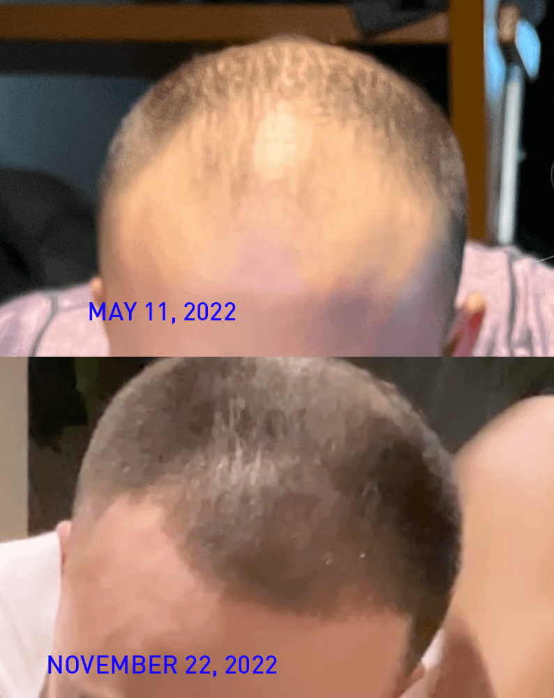 Does Rogaine Work? Real Reddit Answers & Science