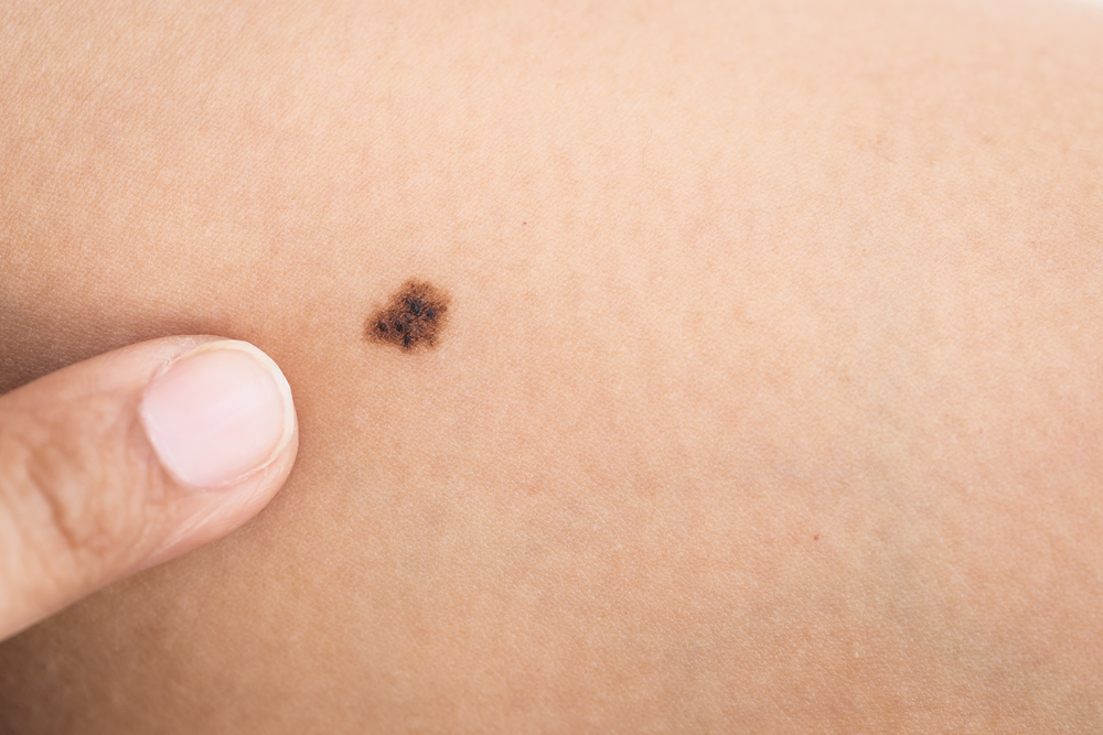 Early Stage Pictures of Cancerous Moles: Quick Guide