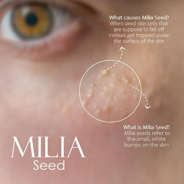 Hard White Seed Under Skin – What It Is & How to Treat It