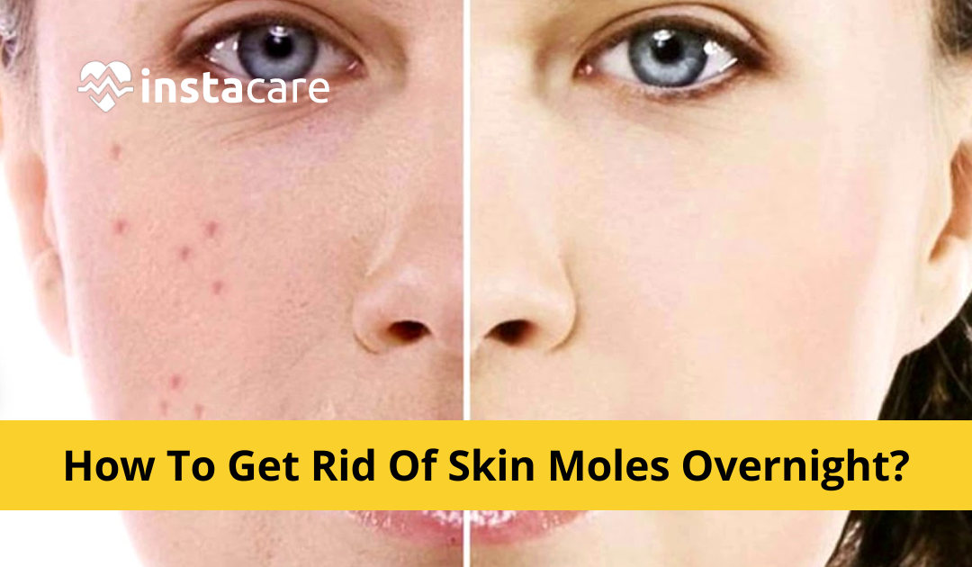 How to Remove Moles from Face Naturally – Home Tips