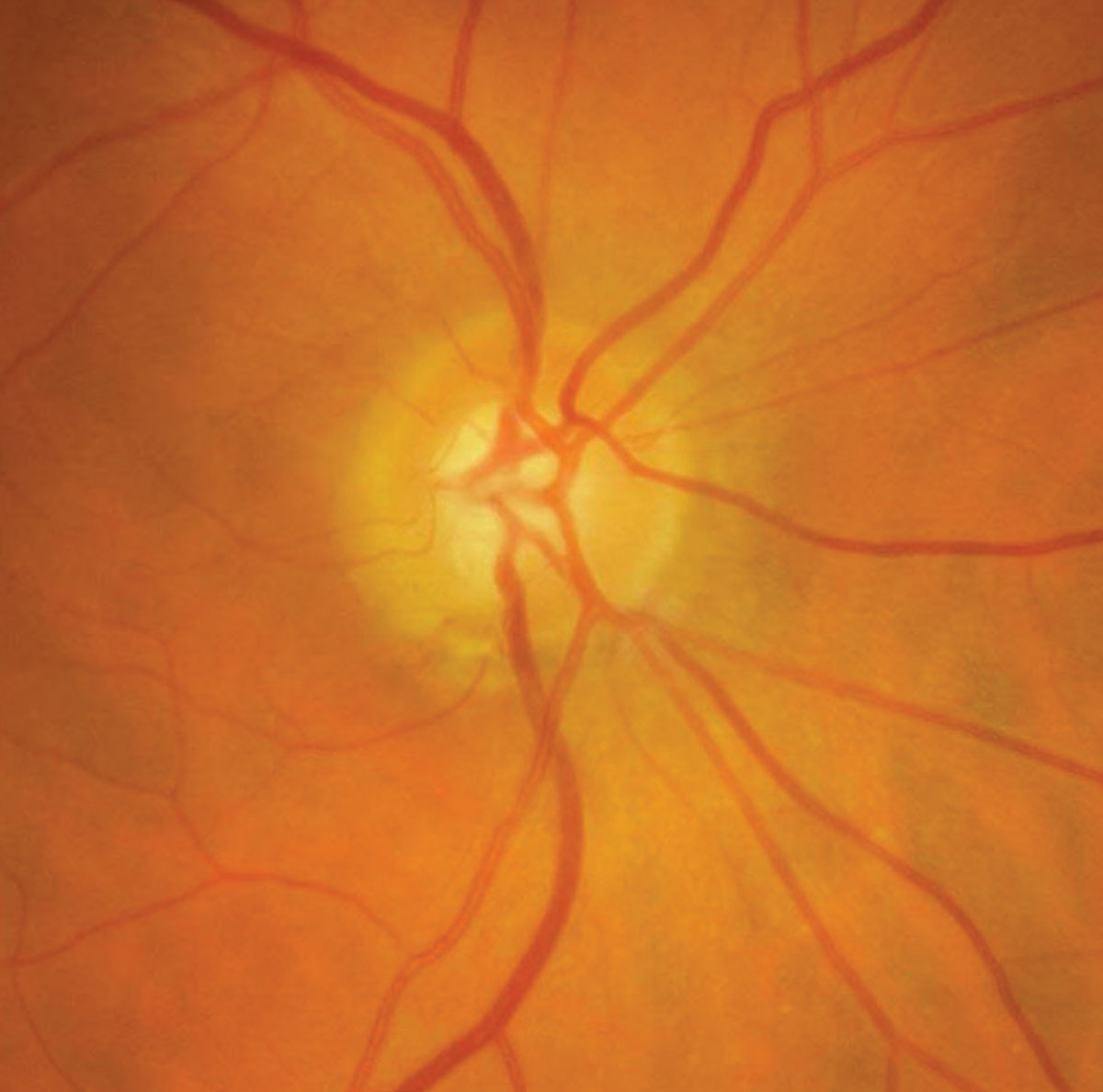 Is Normal‑Tension Glaucoma Harder to Treat? Find Out
