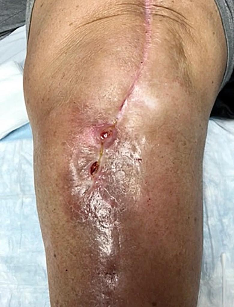 Knee Infection Pictures: Spot Signs, Causes & Care
