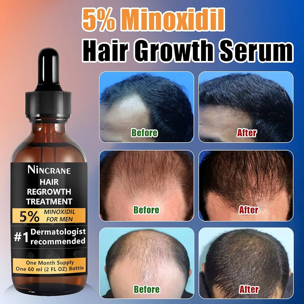 Minoxidil (Rogaine) – How It Works, Uses & Risks