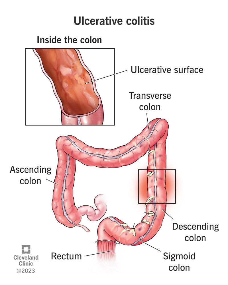 Permanent Cure for Ulcerative Colitis – Fact vs. Hope