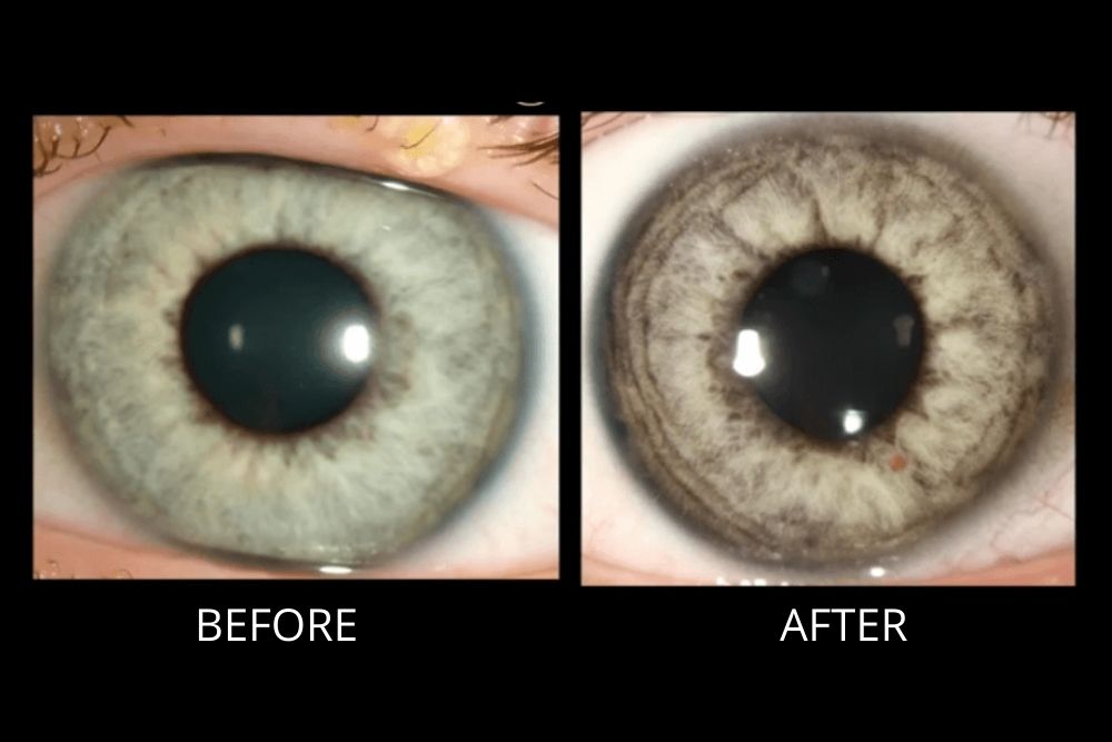 Pigment Dispersion Syndrome Floaters: Quick Guide