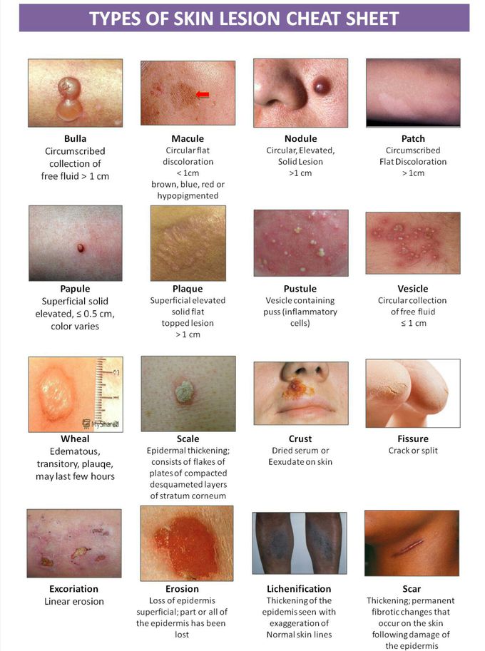 Primary and Secondary Skin Lesions Guide