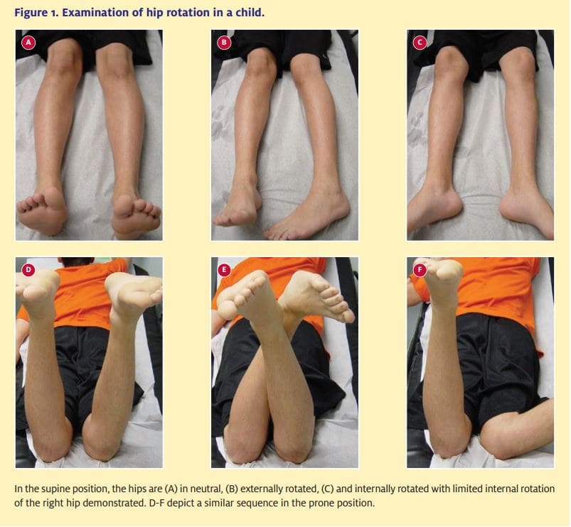 Transient Synovitis of Knee in Child – Quick Guide