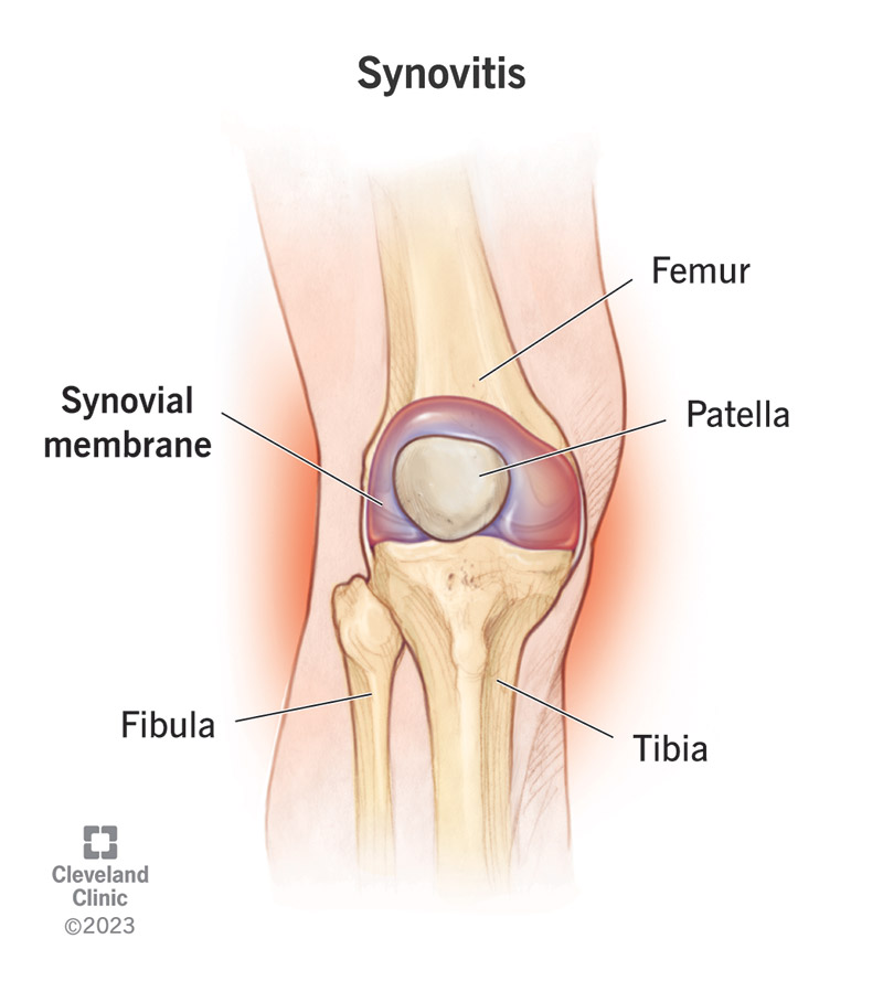 Transient Synovitis of Knee: Causes & Treatment