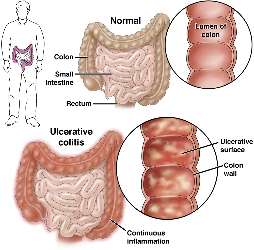 Ulcerative Colitis Cured in Just 1 Week? Risks & Hope