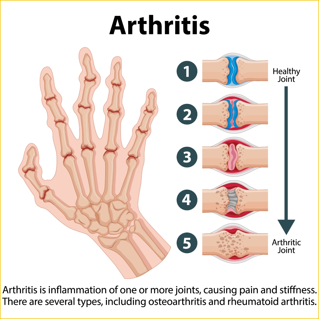 What Causes Arthritis in Young Adults – Quick Guide