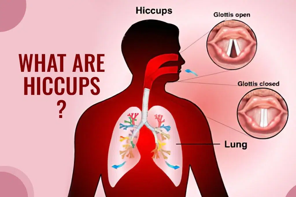 What Causes Hiccups? Quick Answers & Real‑Life Tips