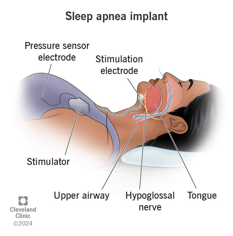 What is the newest treatment for sleep apnea?