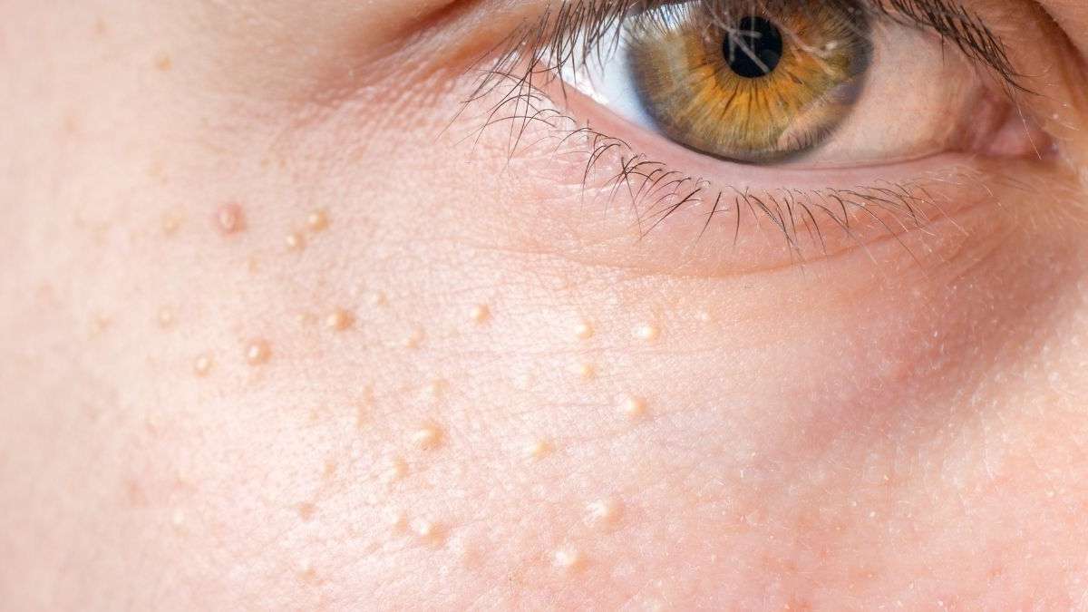 White Bumps on Face Not Milia – Causes & Treatment
