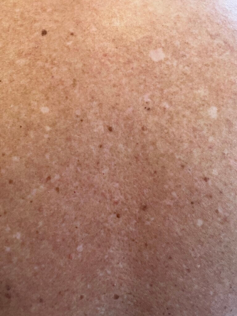 White Moles on Skin Pictures – What They Mean & Worry