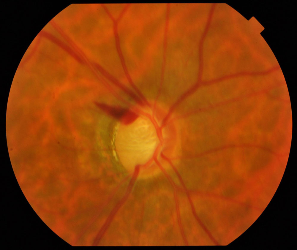 Will I Go Blind From Normal‑Tension Glaucoma? The Truth