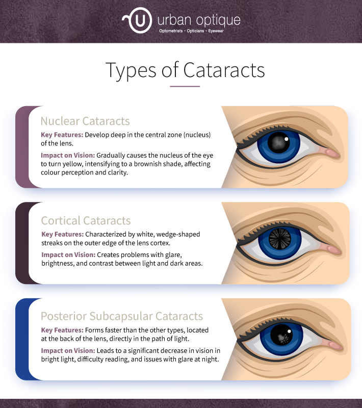 3 Types of Cataract Lenses Explained – Quick Guide