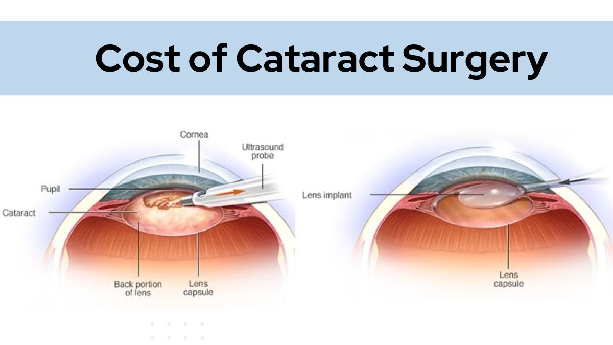 Cataract Surgery Cost: What to Expect Before Booking
