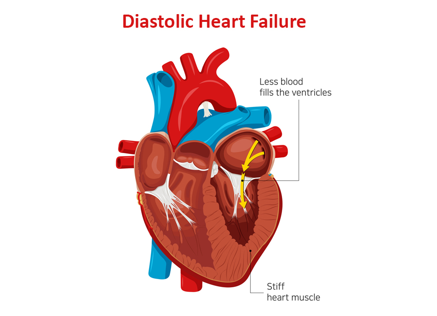 Diastolic Heart Failure: What You Need to Know Today