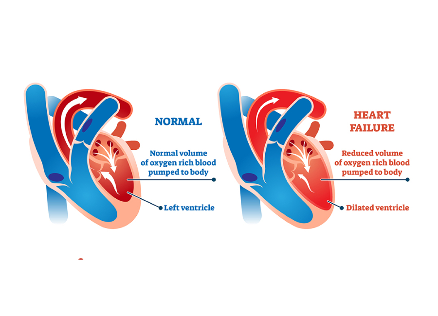 Left‑Sided Heart Failure: Symptoms, Causes & Treatment