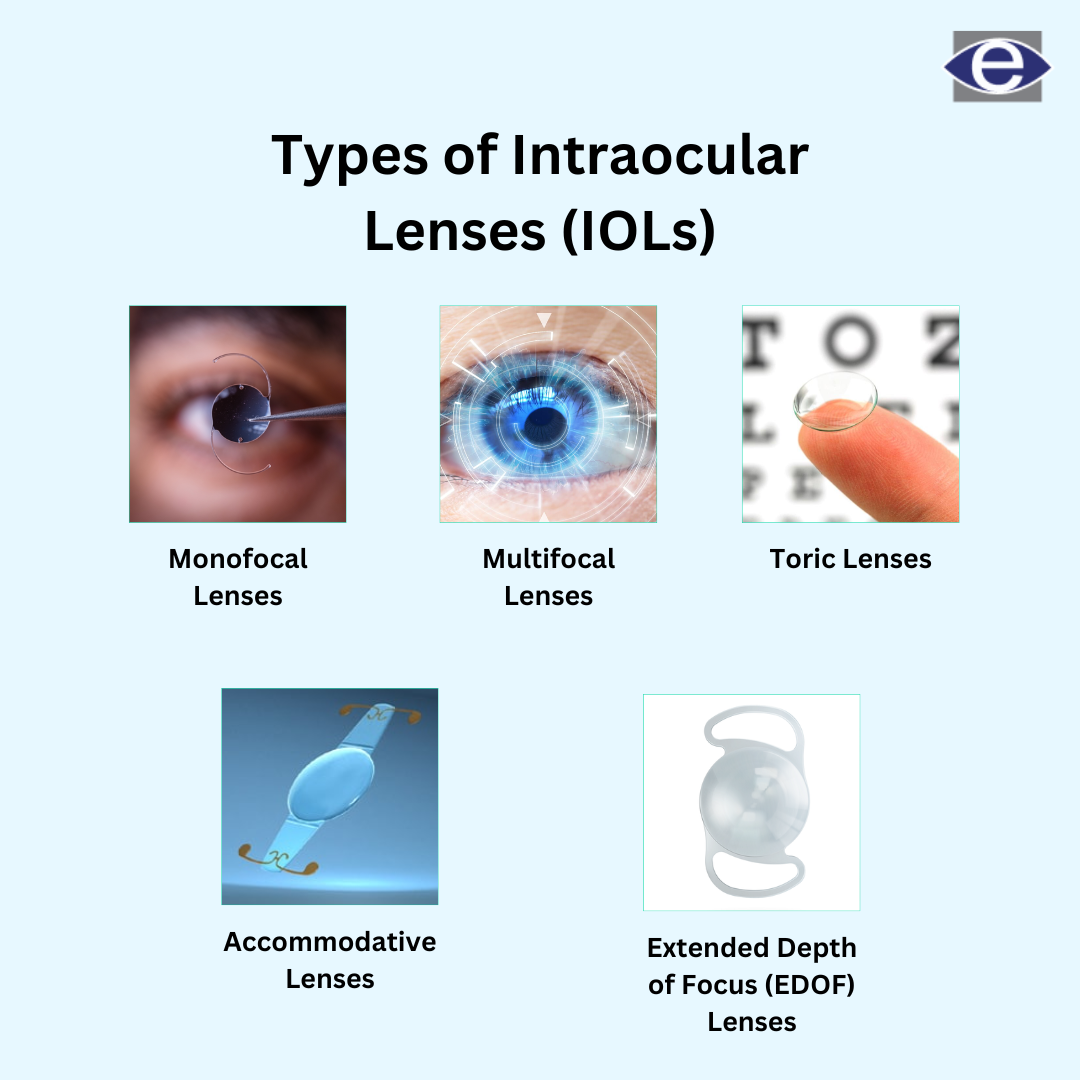 What Are the 4 Types of Cataract Lenses? – Quick Guide