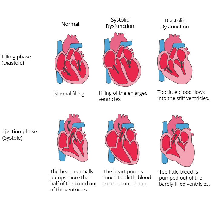 What Are the 4 Types of Heart Failure? Explained Simply