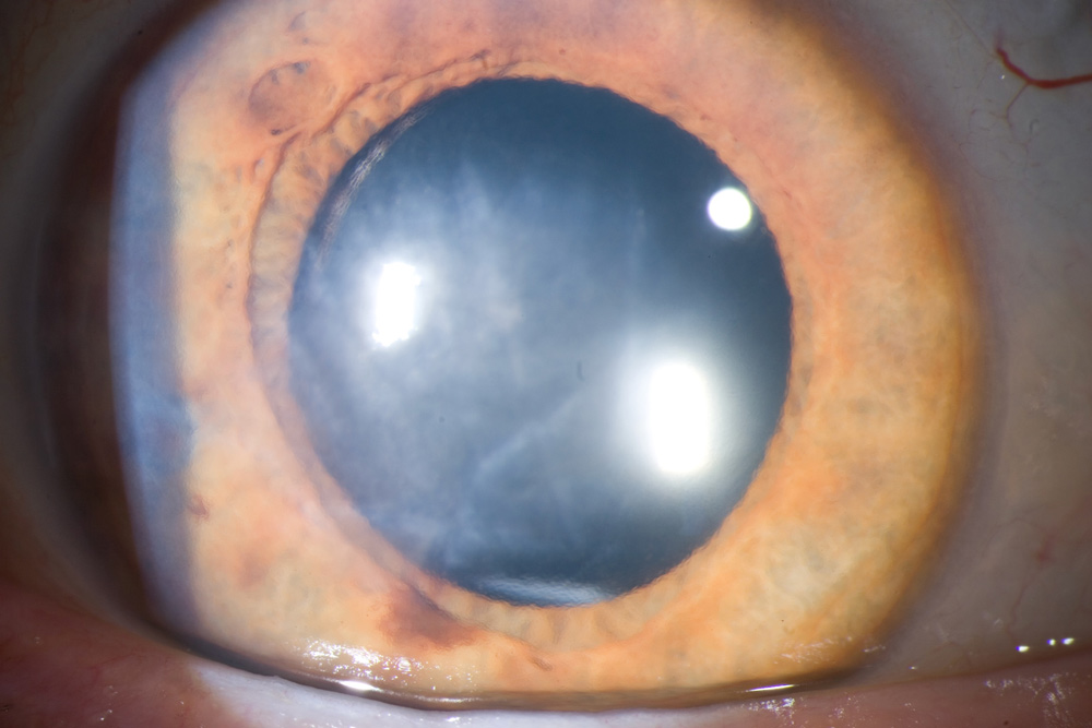 What are the common problems after cataract surgery?