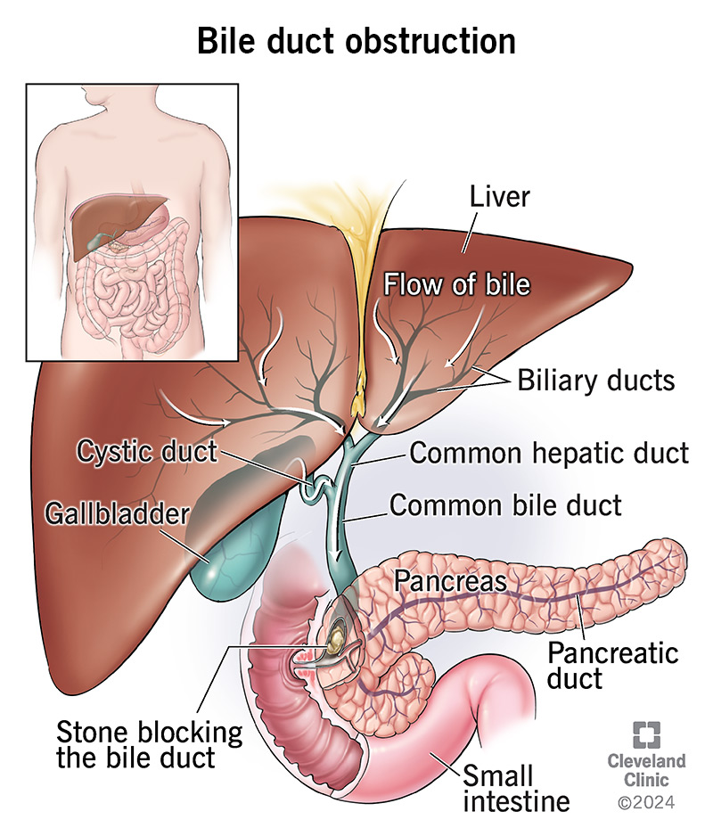 What to Eat When Your Bile Duct Is Blocked Quick Guide