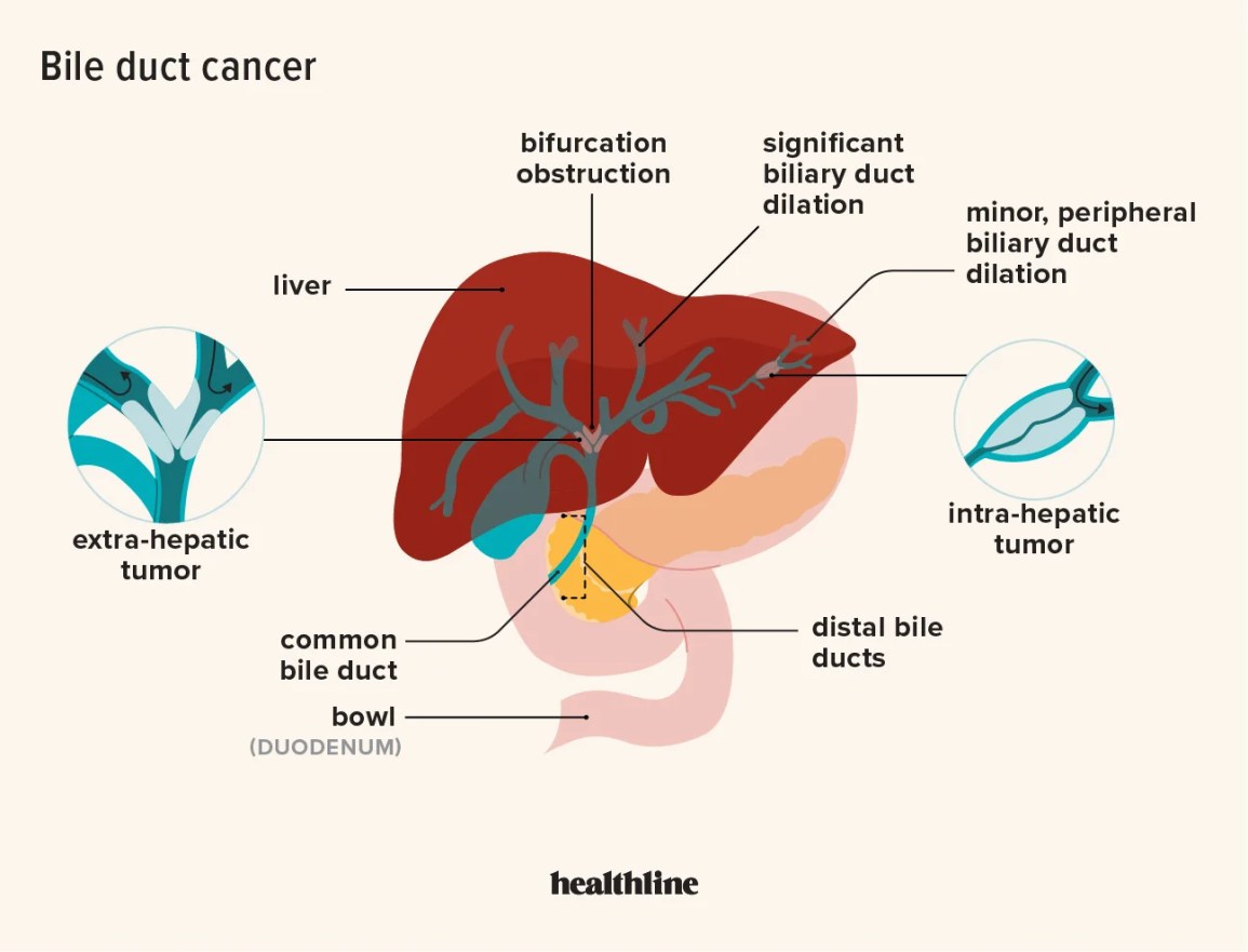 What Happens in the Final Stages of Bile Duct Cancer