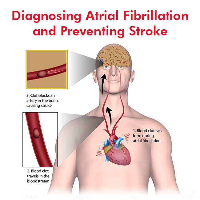 Can Atrial Fibrillation Cause Blood Clots in Legs?