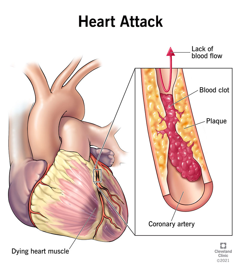 How to Treat a Blood Clot in the Heart: Simple Steps