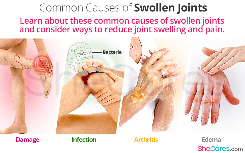 Joint Swelling Meaning: Symptoms, Causes & What to Do