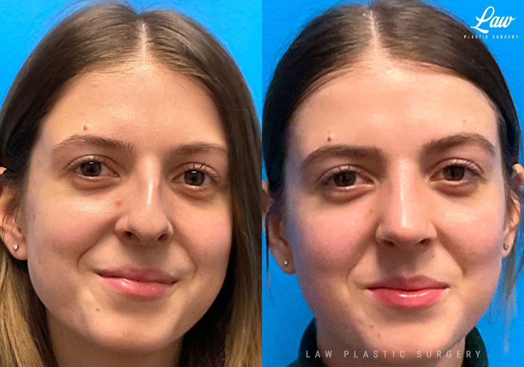 Nose Surgery Before and After – Photos, Costs & Results