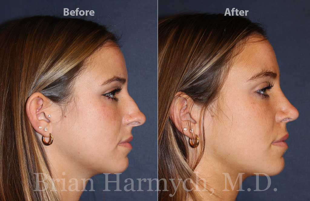 Nose Surgery Near Me – What You Need to Know Before Rhinoplasty