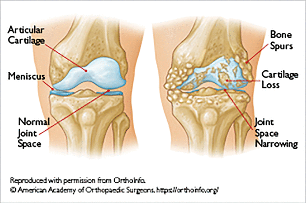 Why Does Obesity Cause Osteoarthritis? The Real Answers