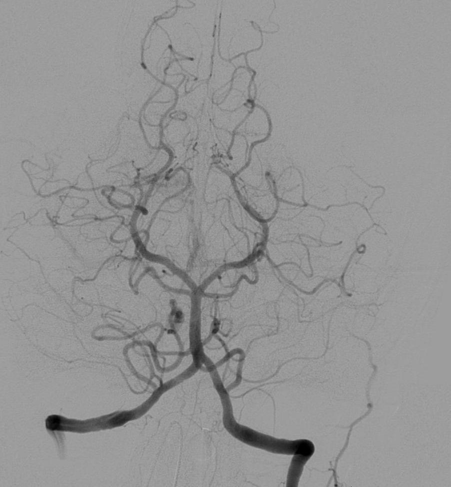 Cerebral Angiogram: What It Is, Risks & Recovery