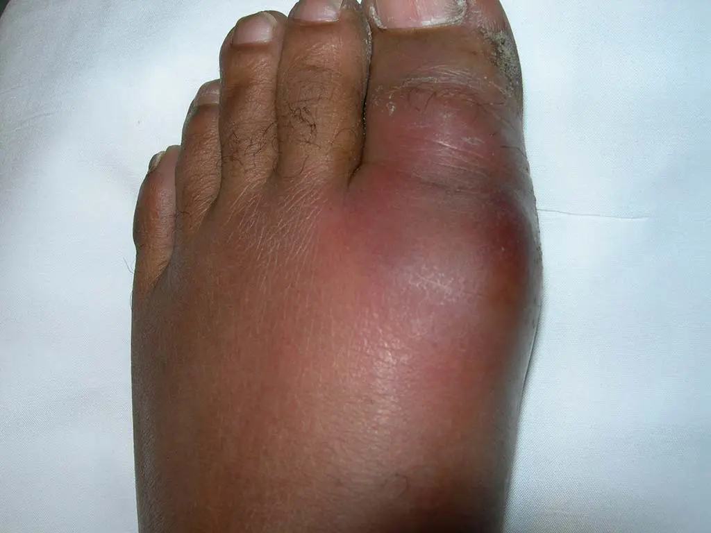 Gout and Sudden Death: What You Need to Know Today