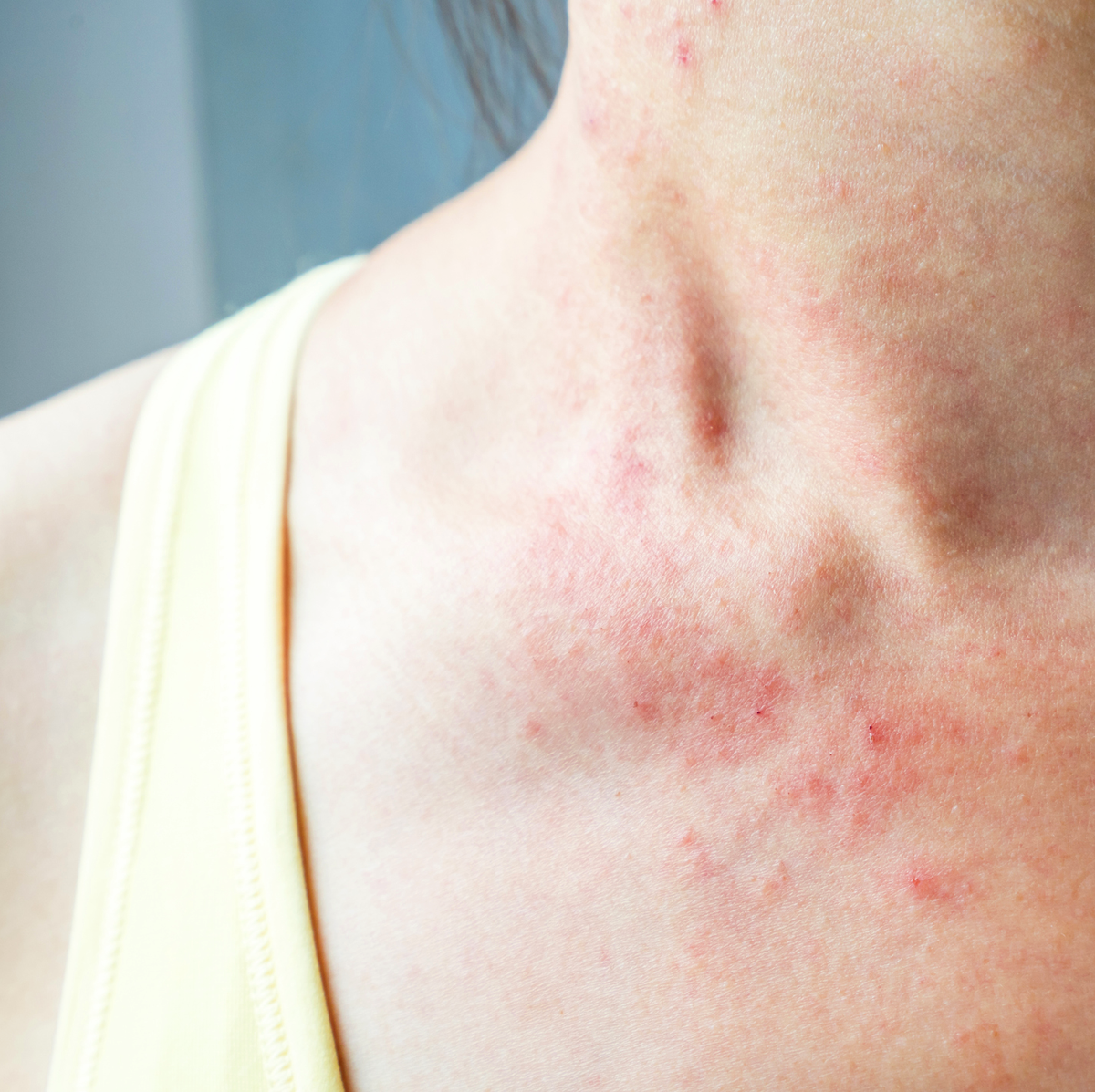 Hormonal Skin Rash Pictures: Identify Causes & Help