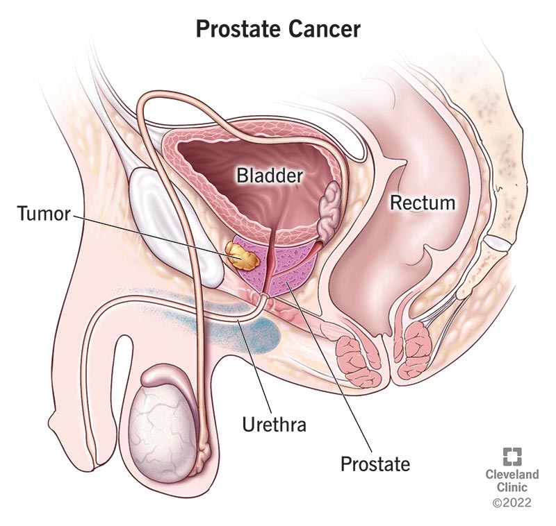 How Does Prostate Cancer Kill You in the End? Understanding the Final Stages