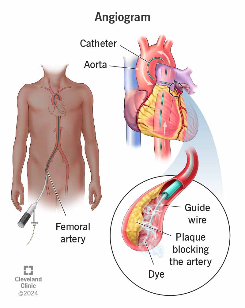 How Long Does Artery Healing Take After an Angiogram?