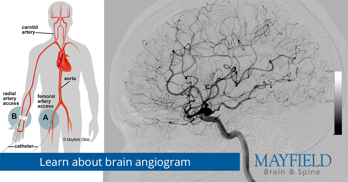 How Serious Is an Angiogram of Brain? Risks Explained