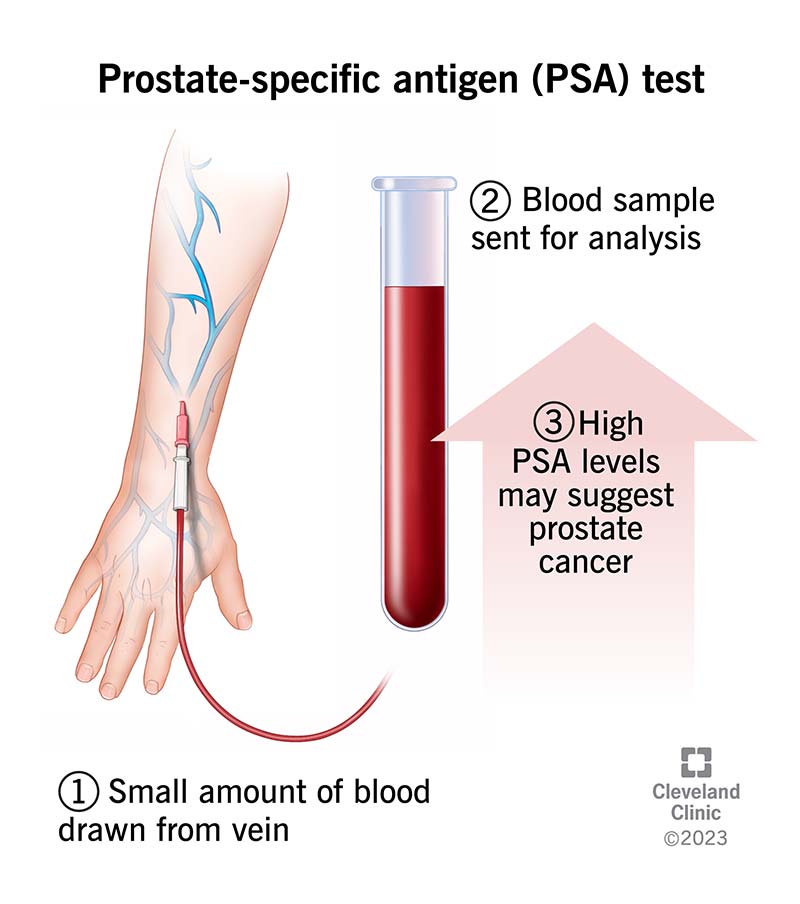How to Lower PSA Before a Test: Quick, Safe Tips