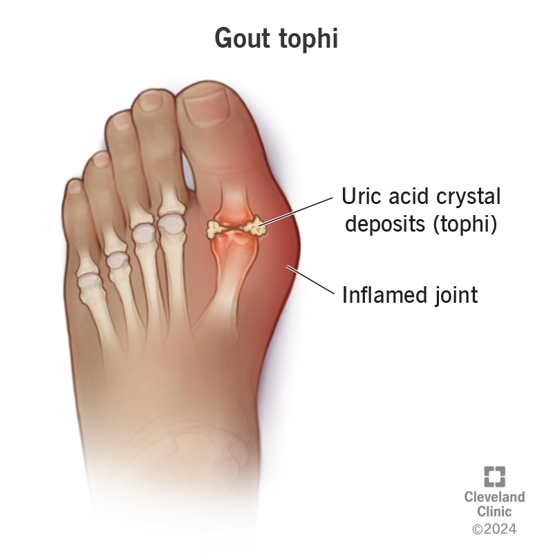 How to Remove Uric Acid Crystals from Joints Naturally