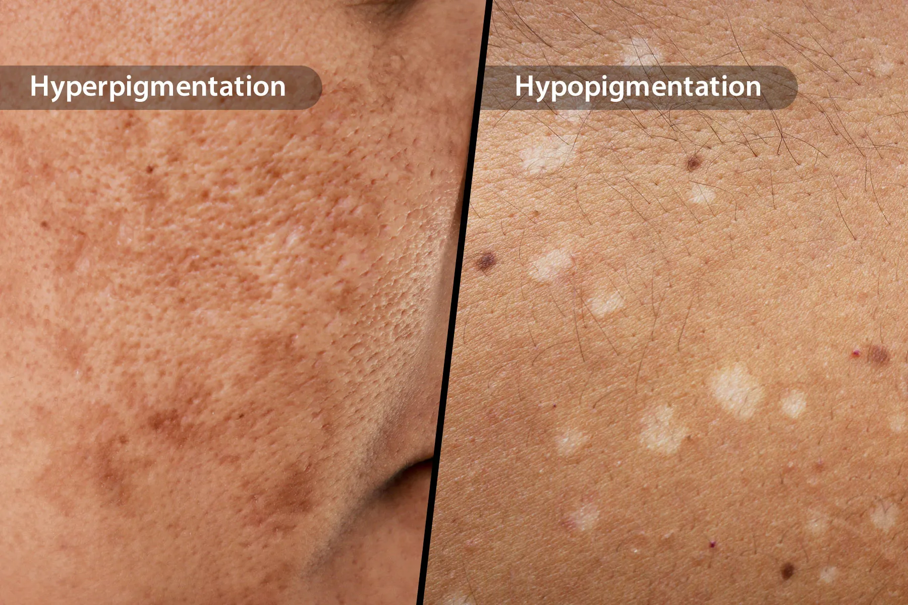 Hypopigmentation Spots: Causes, Risks & Treatment