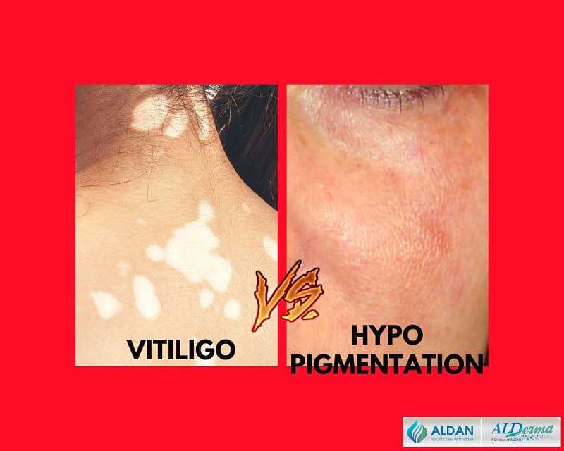 Hypopigmentation vs Vitiligo: Main Differences
