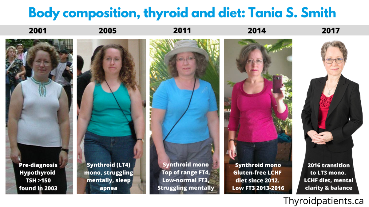 Hypothyroidism Before & After Pictures: Real Changes
