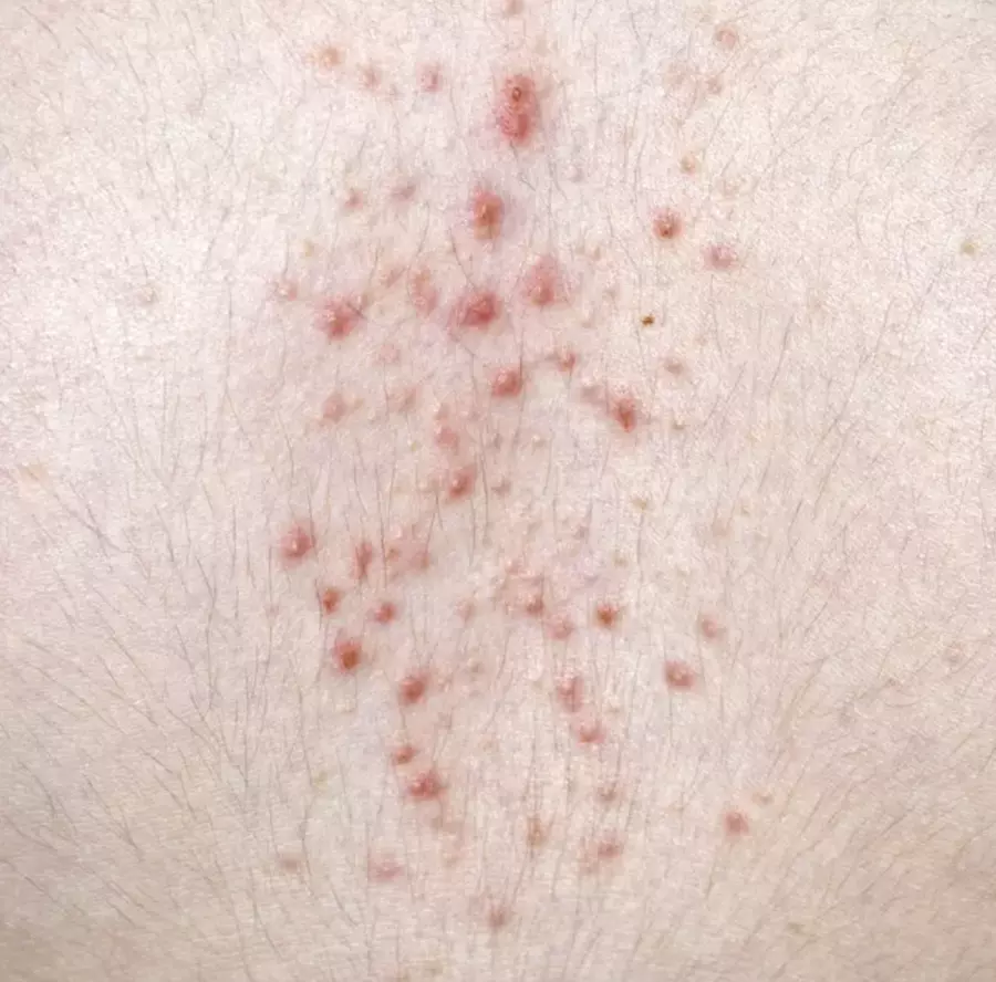 Lung Cancer Rash Pictures: Spot the Signs & What to Do