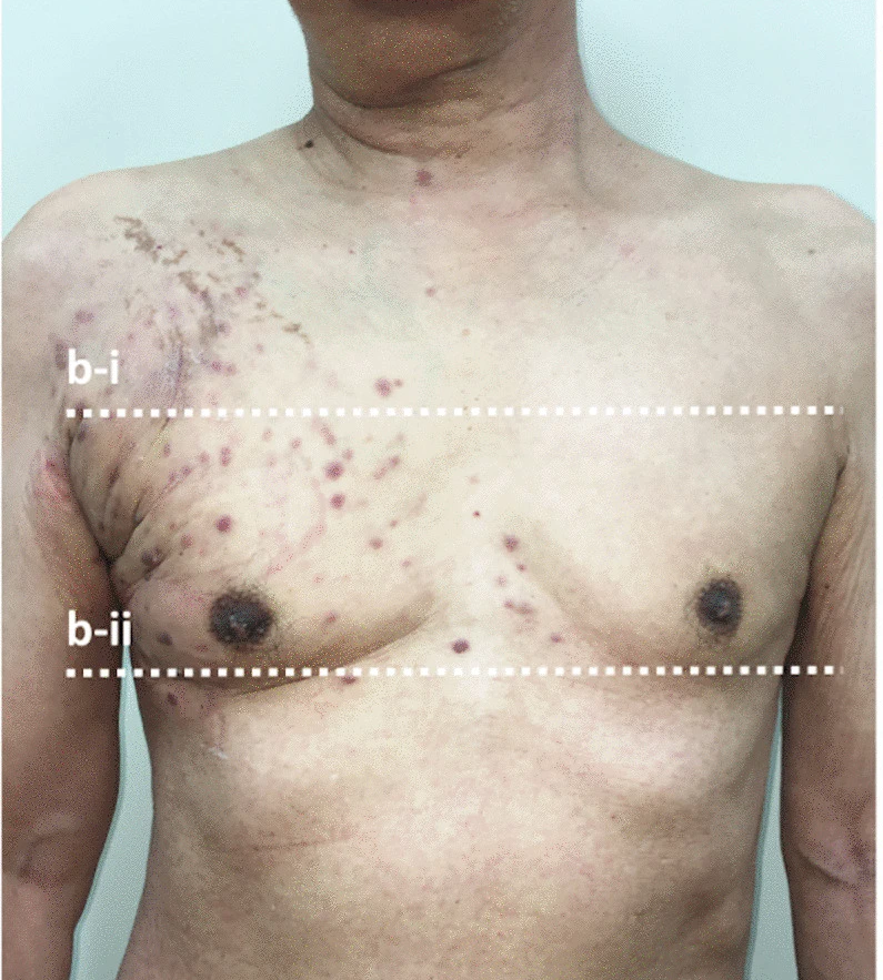 Lung Cancer Skin Metastasis: Signs, Risks & What to Do