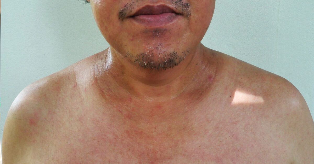 Lung Cancer Skin Symptoms: What to Watch For Today