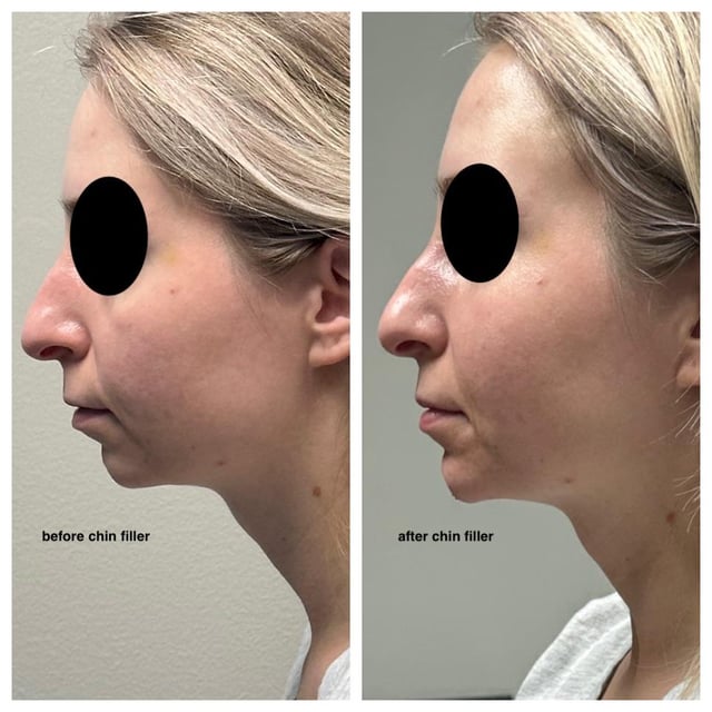 Mouth Breathing After Rhinoplasty Reddit: What’s Normal